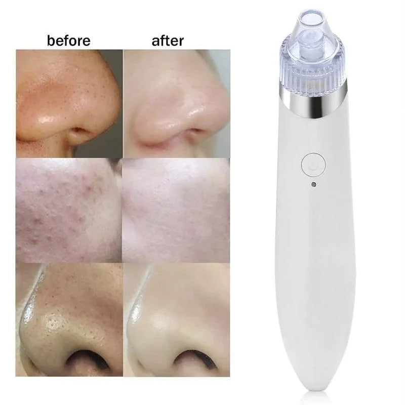 Electric Blackhead Suction Remover – Rose Gold/Silver – view 2